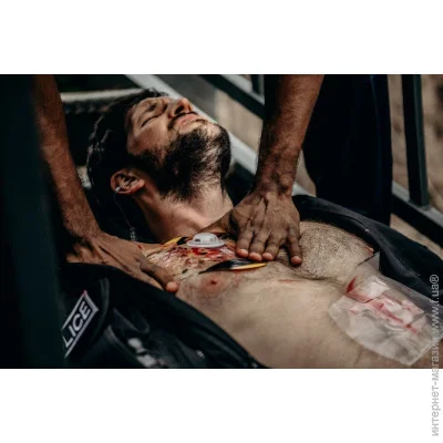 Sam Medical   Chito 7.6   1.8 