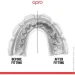 Opro  Instant Single Colour Braces  ( 11+ ) Clear (art.102522007)